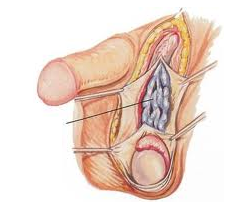 Cáncer de testículo