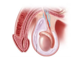 Hidrocele