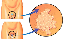 Virus del papiloma humano (HV)