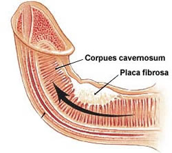 Enfermedades de Peyronié