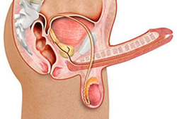 Enfermedades de Priapismo