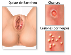 Enfermedades ulcerativas de genitales