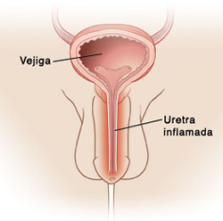 Uretritis